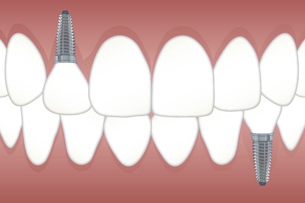 Implantes dentales en adultos