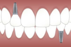 Implantes dentales en adultos